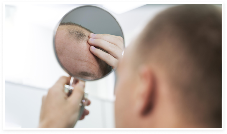 hombre con pérdida de cabello mirándose al espejo