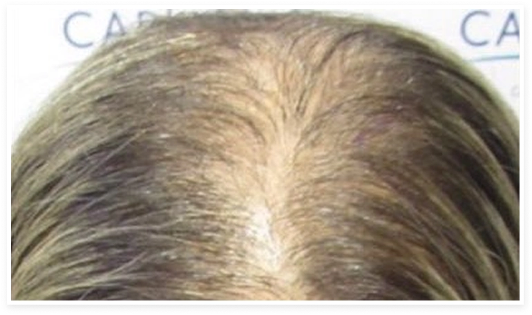 Mujer con alopecia
