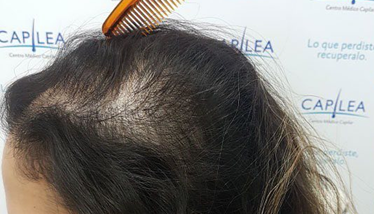 Mujer con alopecia